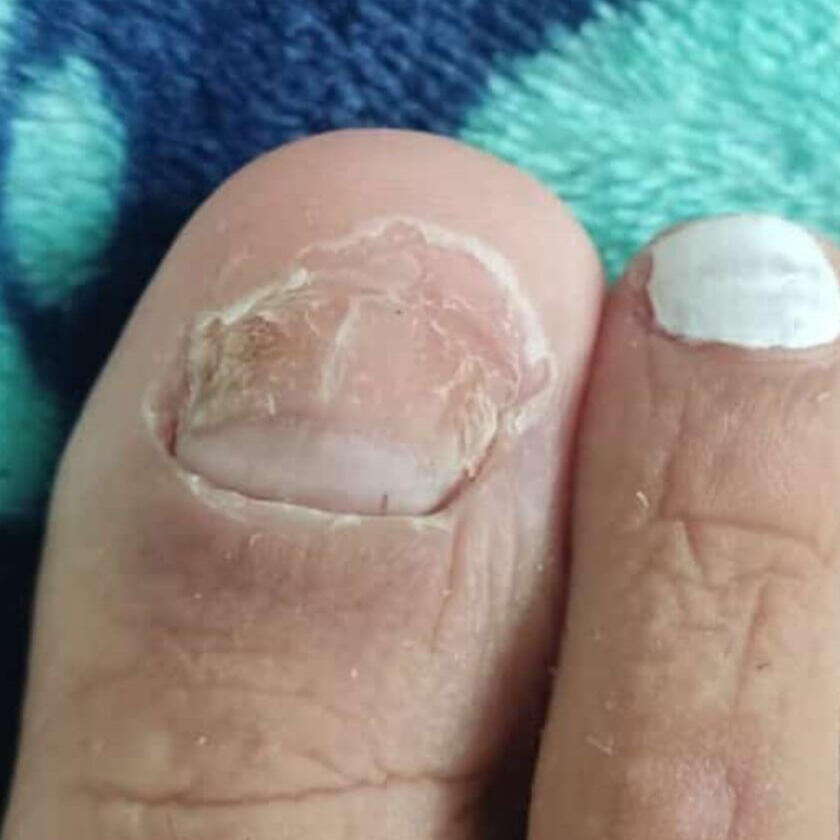 onicomicosis