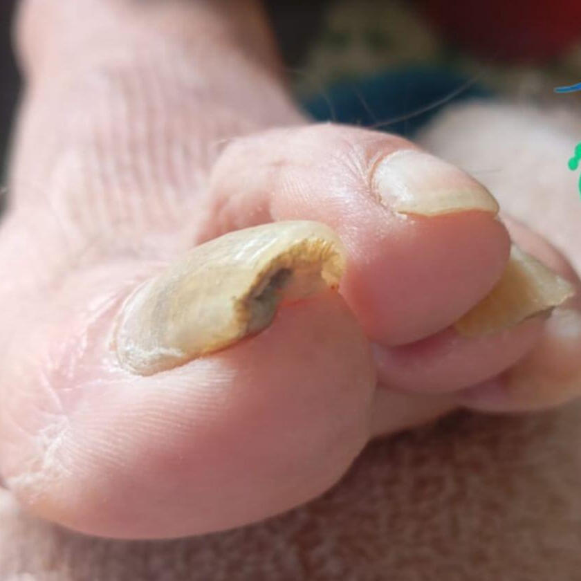 uñas gruesas